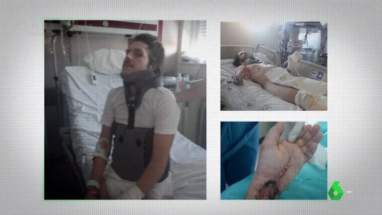 "Me hice 40 fracturas y ni me llamaron": el relato de un camarero que sufrió un accidente laboral con un contrato fraudulento "Me hice 40 fracturas y ni me llamaron": el relato de un camarero que sufrió un accidente laboral con un contrato fraudulento