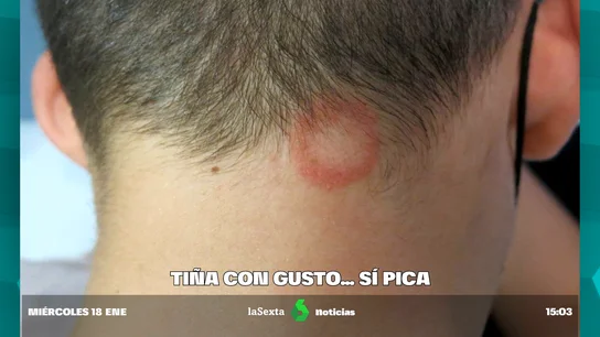 Alerta por brotes de tiña en peluquerías de España por la moda del rasurado entre los jóvenes Alerta por brotes de tiña en peluquerías de España por la moda del rasurado entre los jóvenes