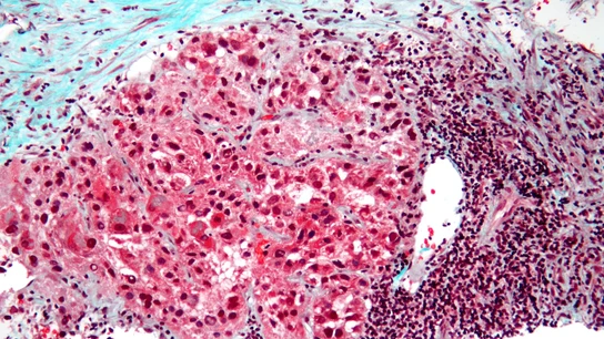 carcinoma hígado carcinoma hígado
