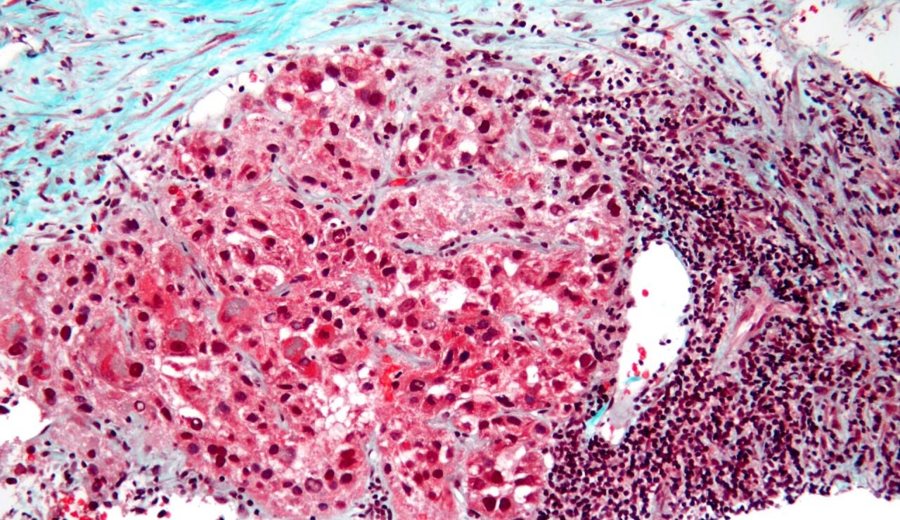 carcinoma hígado