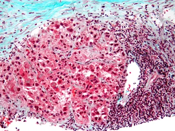 carcinoma hígado carcinoma hígado