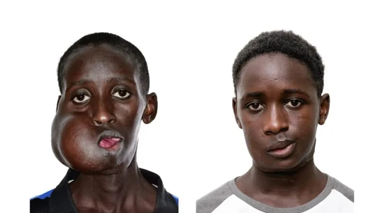 El joven Mamadou Seydou antes y después de la operación. El joven Mamadou Seydou antes y después de la operación.