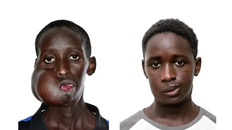 El joven Mamadou Seydou antes y después de la operación.