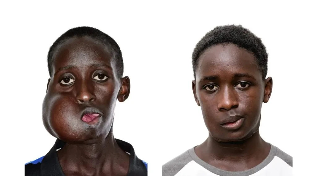 El joven Mamadou Seydou antes y después de la operación.