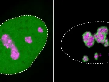 Los condensados de proteinas causan muchos tipos de enfermedades geneticas Los condensados de proteinas causan muchos tipos de enfermedades geneticas