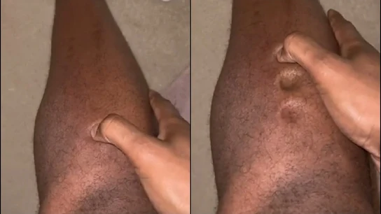 La infección en las piernas de un atelta La infección en las piernas de un atelta