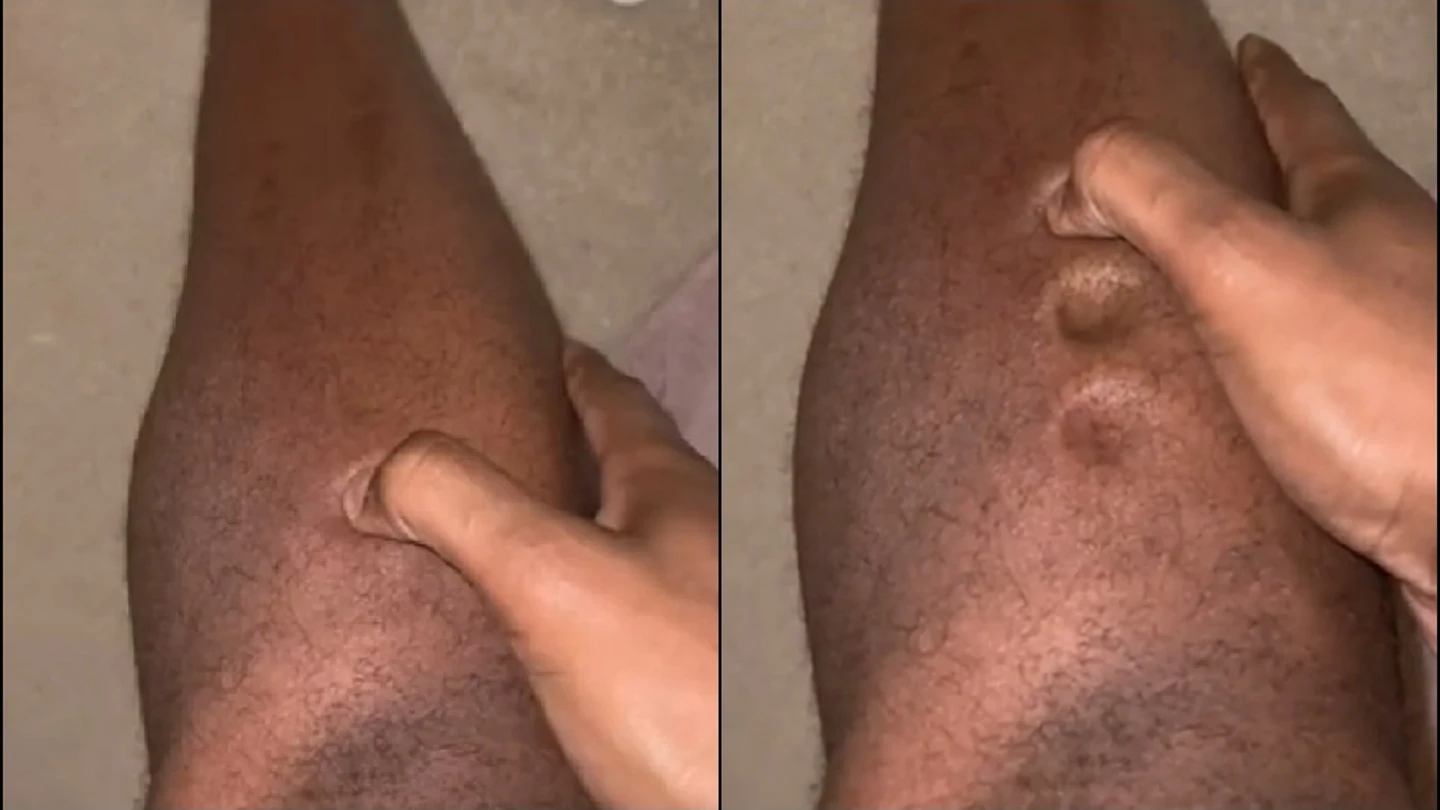 La infección en las piernas de un atelta La infección en las piernas de un atelta