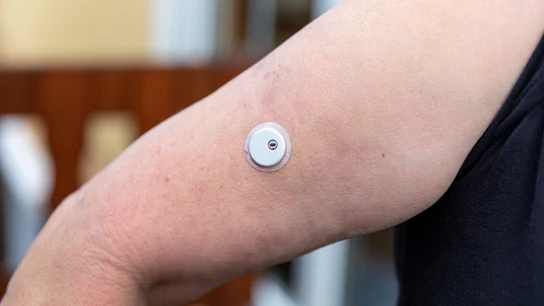 Sensor en el brazo para medir la glucosa Sensor en el brazo para medir la glucosa