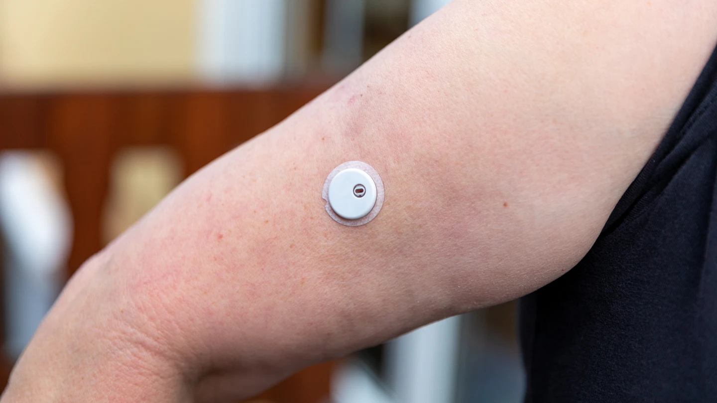 Sensor en el brazo para medir la glucosa Sensor en el brazo para medir la glucosa