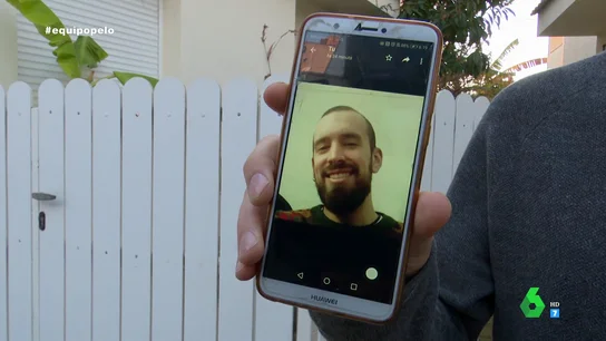 Trasplantes de pelo que acaban en catástrofes capilares: "Llevo gastados 10.000 euros en tres operaciones" Trasplantes de pelo que acaban en catástrofes capilares: "Llevo gastados 10.000 euros en tres operaciones"