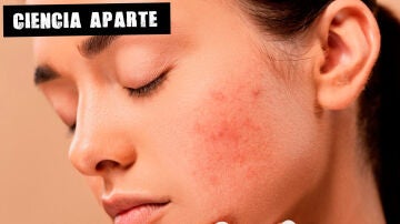 Cómo cuidar la piel si estás siguiendo un tratamiento para el acné