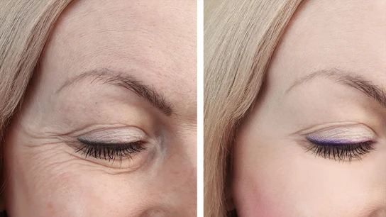 Imagen de archivo de un antes y después de la blefaroplastia Imagen de archivo de un antes y después de la blefaroplastia