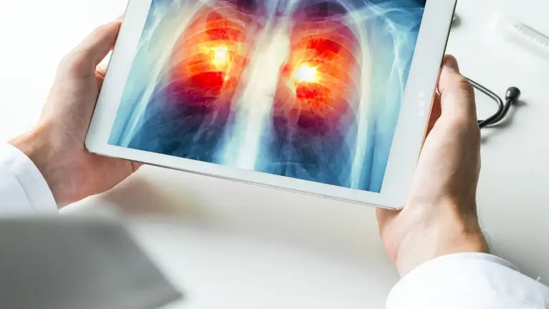 Los motivos del preocupante aumento de diagnósticos de cáncer de pulmón, más allá del tabaco