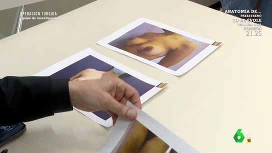 "Le faltaba piel, tenía necrosis": un cirujano plástico muestra los desastres de pacientes operadas en Turquía "Le faltaba piel, tenía necrosis": un cirujano plástico muestra los desastres de pacientes operadas en Turquía