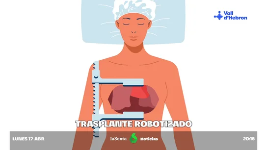 Realizan el primer trasplante de pulmón totalmente robotizado en el Hospital Vall d'Hebron: "El dolor ha sido cero" Realizan el primer trasplante de pulmón totalmente robotizado en el Hospital Vall d'Hebron: "El dolor ha sido cero"