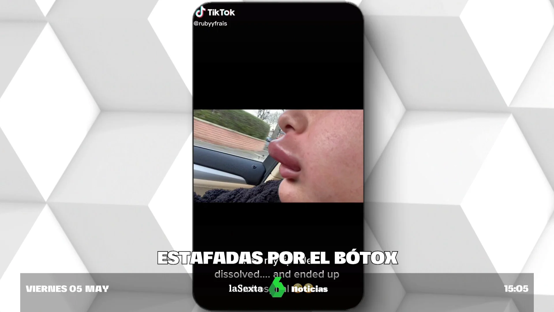 María, afectada por un "destrozo" con bótox: "Según pasaban los días los labios se me inflamaban y endurecían más"