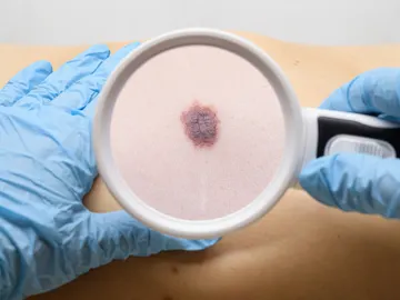 Examen de un lunar en el cuerpo del paciente Examen de un lunar en el cuerpo del paciente