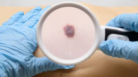 Examen de un lunar en el cuerpo del paciente Examen de un lunar en el cuerpo del paciente