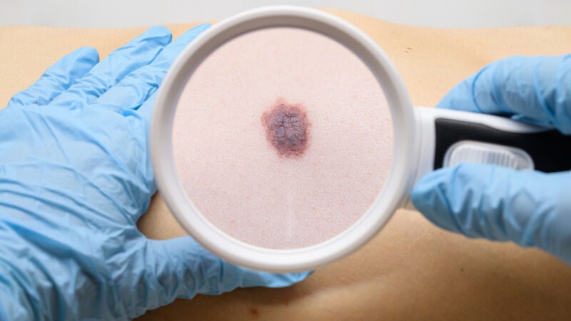 Detectan el cáncer de piel más pequeño del mundo, de 0,65 milímetros