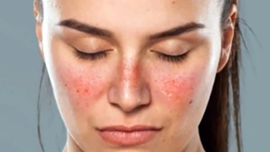 Qué es el lupus y cuáles son sus síntomas: "Un tratamiento precoz es clave para evitar daños irreversibles" Qué es el lupus y cuáles son sus síntomas: "Un tratamiento precoz es clave para evitar daños irreversibles"