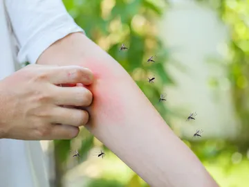Un hombre se rasca la picadura de un mosquito en el brazo Un hombre se rasca la picadura de un mosquito en el brazo