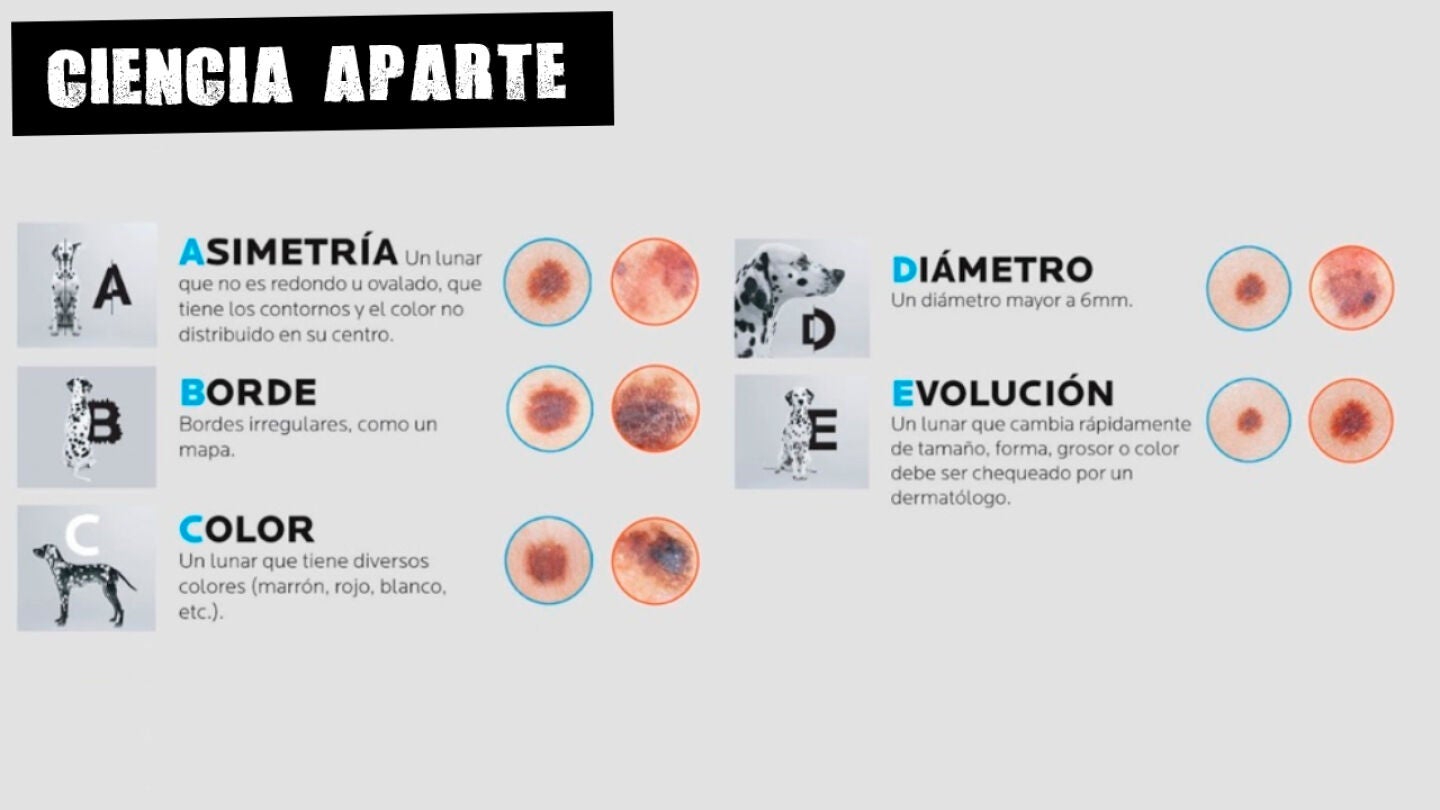 Ilustraci&oacute;n del m&eacute;todo ABCDE para detectar lunares sospechosos 