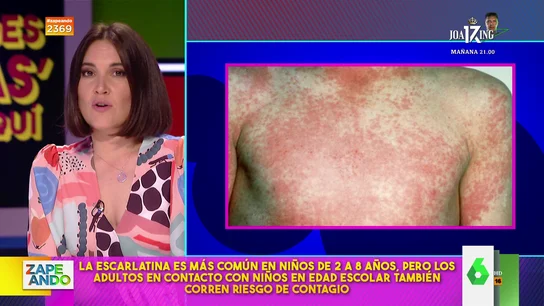 No, la escarlatina no solo la padecen los niños: Boticaria García explica cómo afecta a los adultos No, la escarlatina no solo la padecen los niños: Boticaria García explica cómo afecta a los adultos