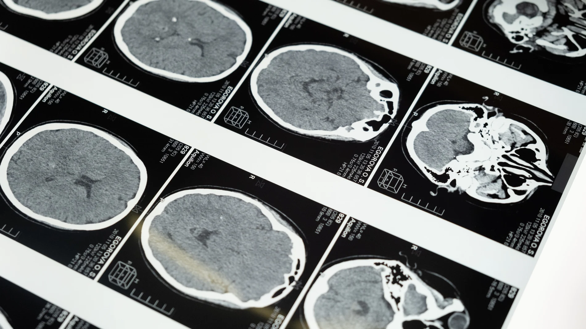 Los neurólogos explican cuáles son los síntomas para detectar un tumor cerebral