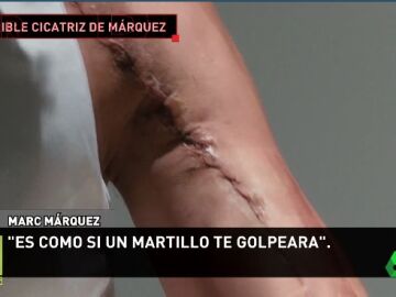 As&iacute; es la espeluznante cicatriz del hombro de Marc M&aacute;rquez