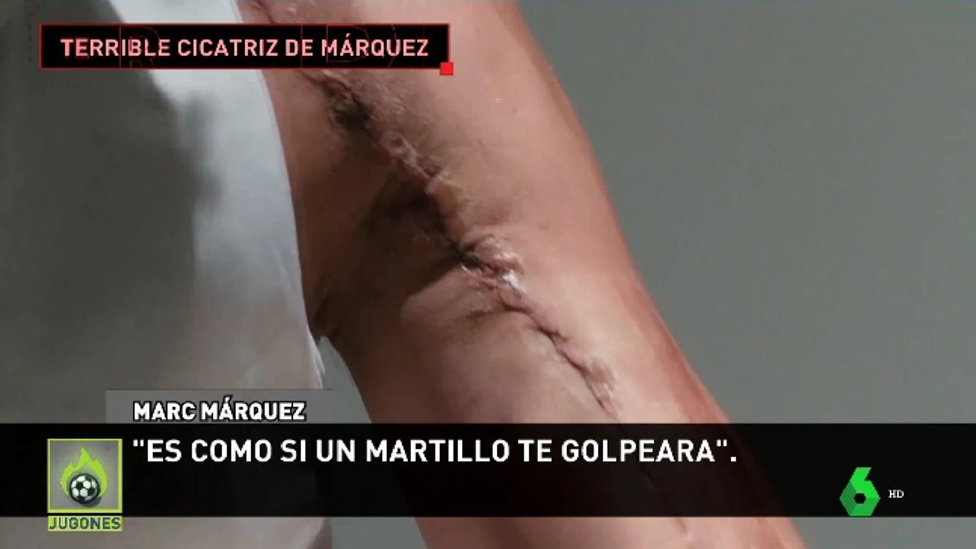 Así es la espeluznante cicatriz del hombro de Marc Márquez