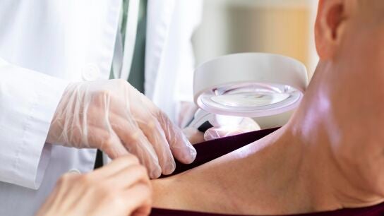 As&iacute; son las se&ntilde;ales del c&aacute;ncer de piel no melanoma: cada a&ntilde;o se diagnostican en Espa&ntilde;a 74.000 casos