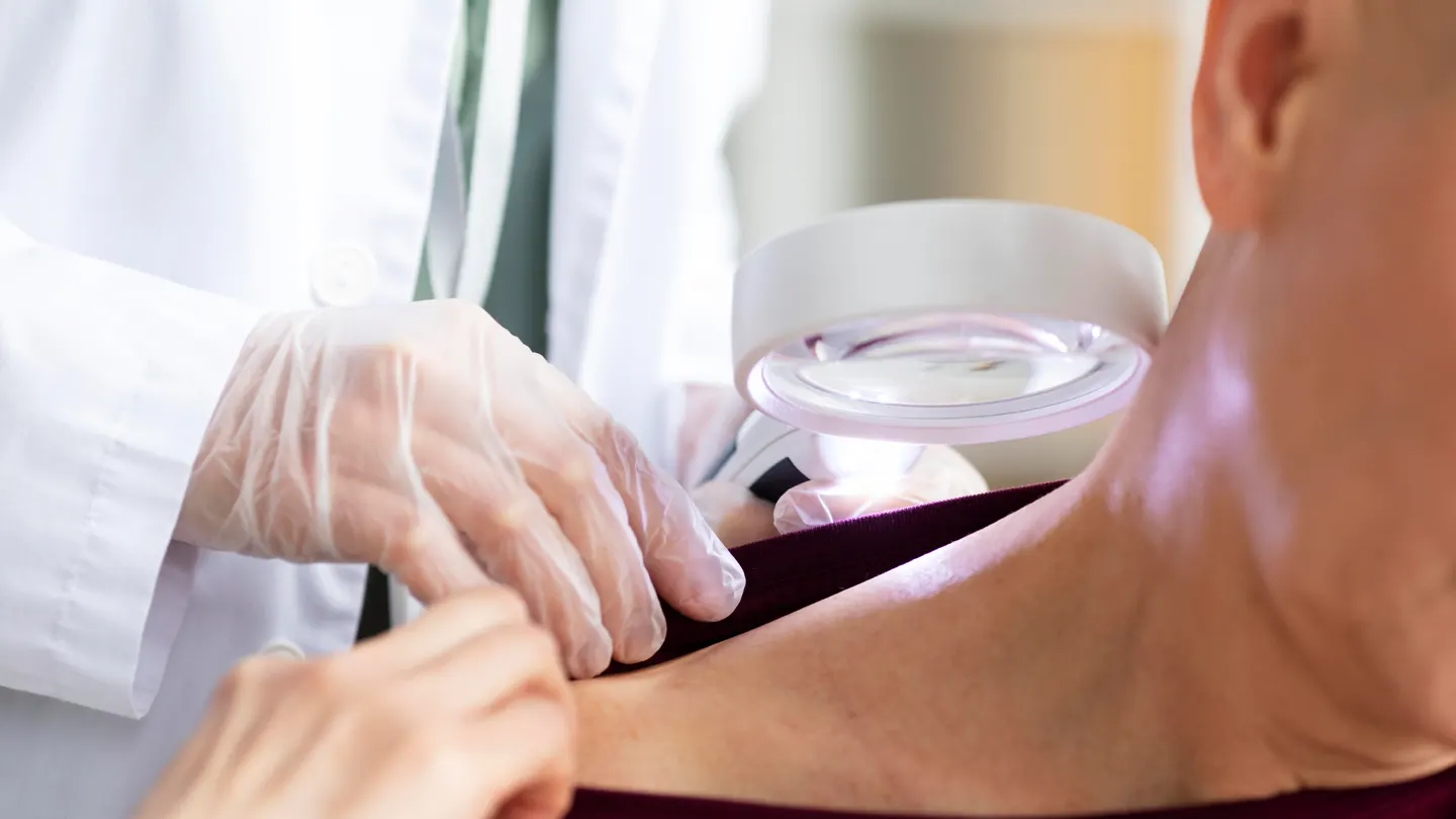 Así son las señales del cáncer de piel no melanoma: cada año se diagnostican en España 74.000 casos Así son las señales del cáncer de piel no melanoma: cada año se diagnostican en España 74.000 casos