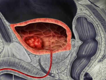 Ilustración 3D de un cáncer de vejiga