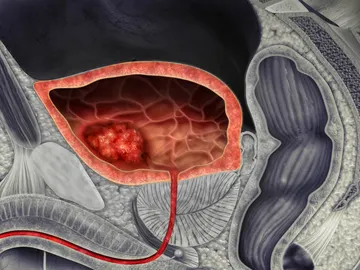 Ilustración 3D de un cáncer de vejiga Ilustración 3D de un cáncer de vejiga