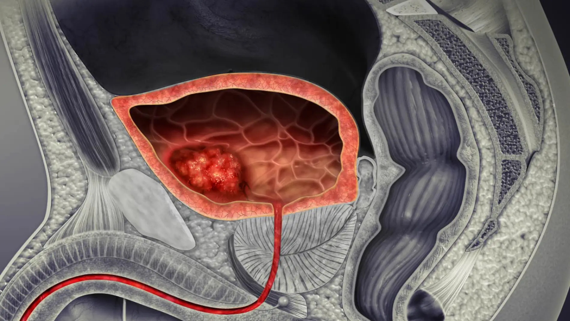 Ilustración 3D de un cáncer de vejiga Ilustración 3D de un cáncer de vejiga
