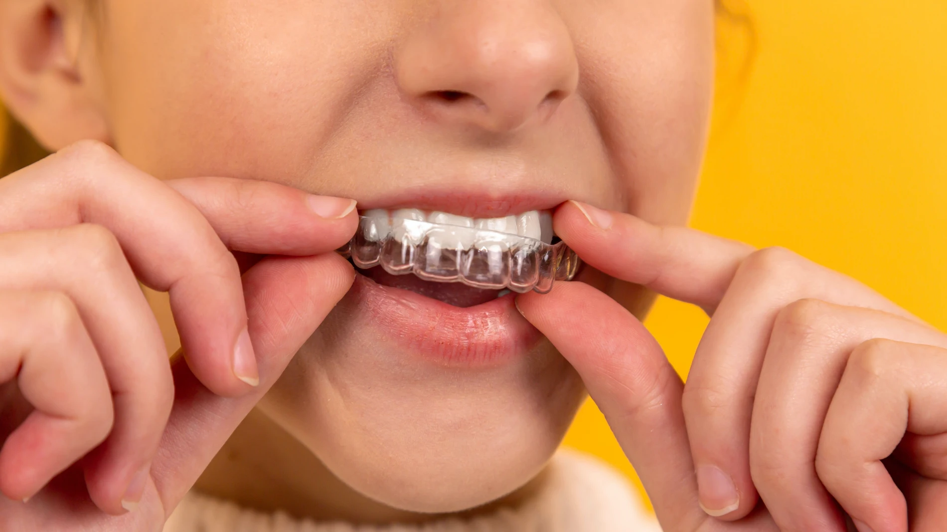 Qué es el bruxismo y por qué es necesaria une fédula dental de descarga para tratarlo