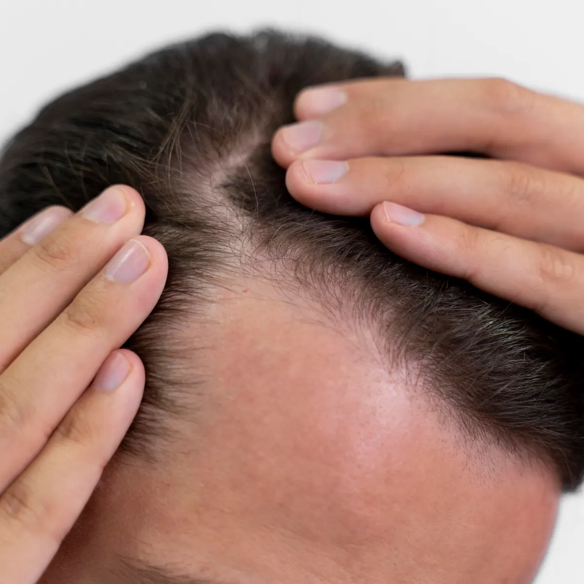 La pastilla 'milagro' contra calvicie: así es el fármaco que podría recuperar el 80% del pelo en la alopecia aerata