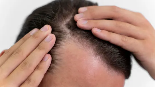 La pastilla 'milagro' contra la calvicie: así es el fármaco que podría recuperar el 80% del pelo en la alopecia aerata La pastilla 'milagro' contra la calvicie: así es el fármaco que podría recuperar el 80% del pelo en la alopecia aerata