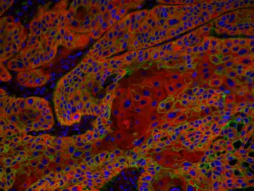 Nueva via frente a los tumores resistentes a la quimioterapia Nueva via frente a los tumores resistentes a la quimioterapia