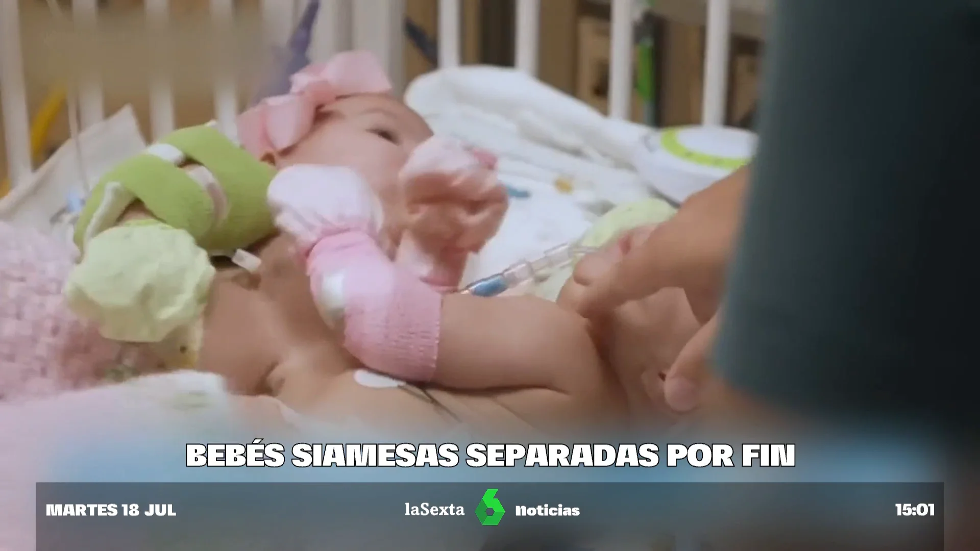 siamesas separadas