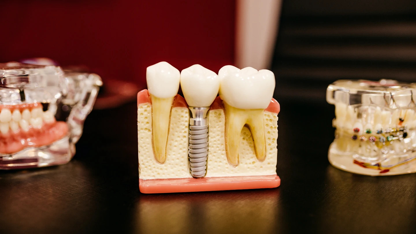 Qué es un implante dental, tipos y precio de esta cirugía dental Qué es un implante dental, tipos y precio de esta cirugía dental