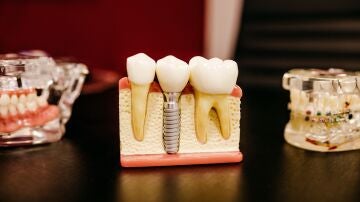 Qué es un implante dental, tipos y precio de esta cirugía dental