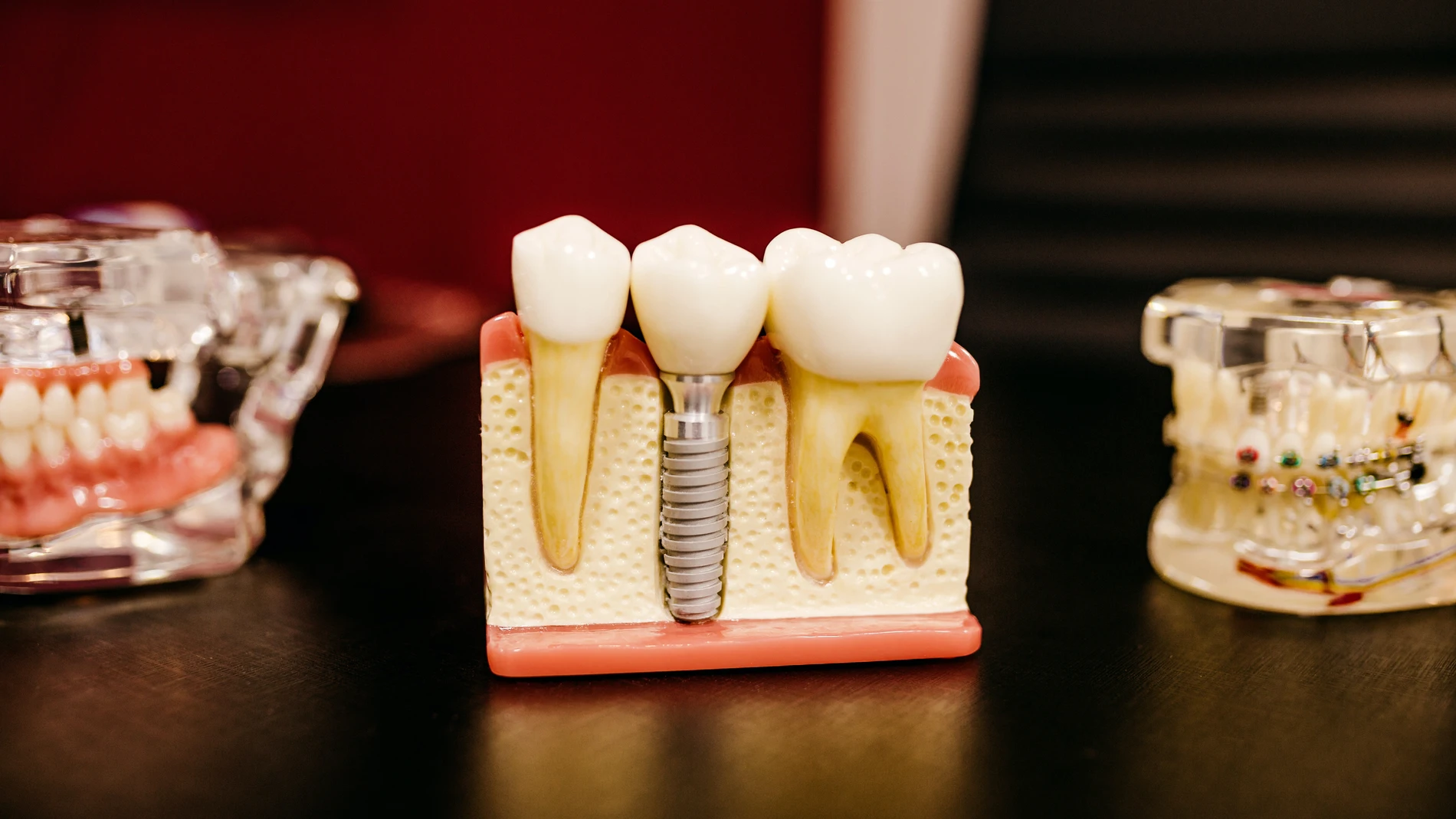 Cómo fijar una prótesis dental: métodos y consejos de limpieza
