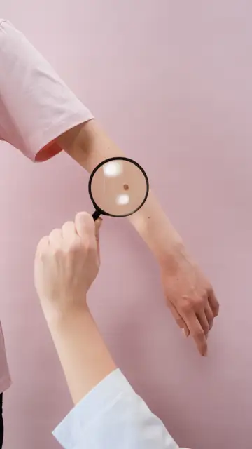 Melanoma Melanoma
