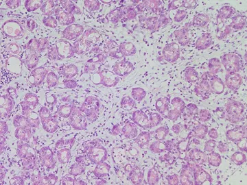 Descubierta una molecula que ayuda a madurar a las celulas del pancreas y limita el desarrollo de tumores Descubierta una molecula que ayuda a madurar a las celulas del pancreas y limita el desarrollo de tumores