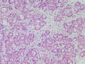 Vacuna experimental cáncer de páncreas Vacuna experimental cáncer de páncreas