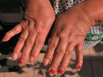 Mil millones de personas sufrirán osteoartritis en 2050, según un estudio Mil millones de personas sufrirán osteoartritis en 2050, según un estudio