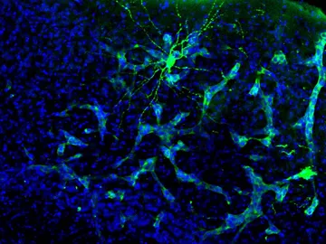 Metástasis en el cerebro de un ratón Metástasis en el cerebro de un ratón