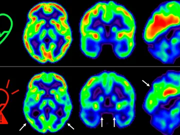 Consumo de glucosa en el cerebro de individuos según su riesgo cardiovascular Consumo de glucosa en el cerebro de individuos según su riesgo cardiovascular