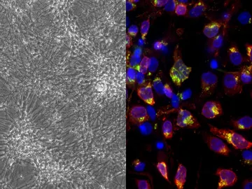 Estudian el posible papel del virus del herpes simple 1 en el alzheimer Estudian el posible papel del virus del herpes simple 1 en el alzheimer
